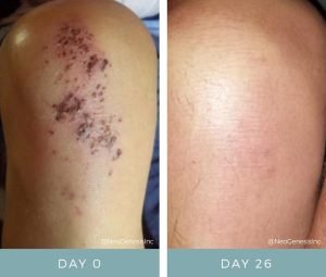 Before + After - Wound Care - Knee