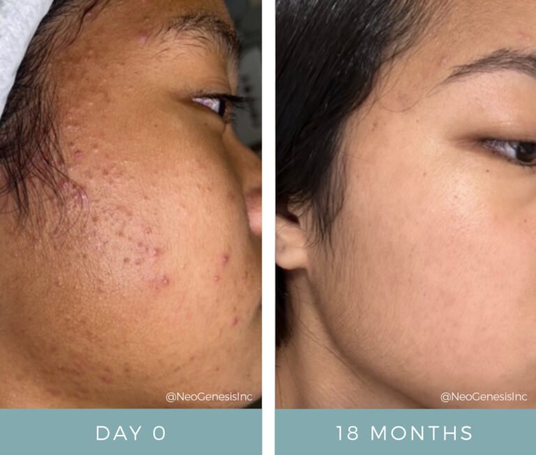 Before + After - Acne