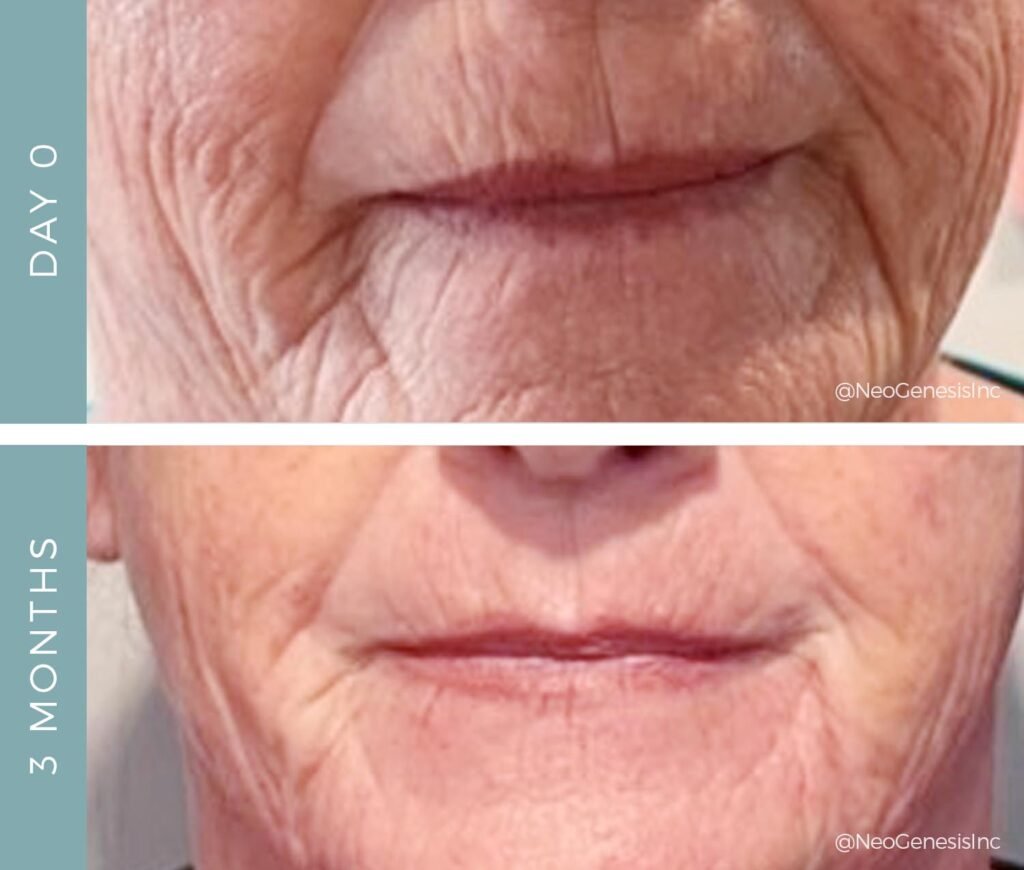 Before + After - Aging Mouth Area