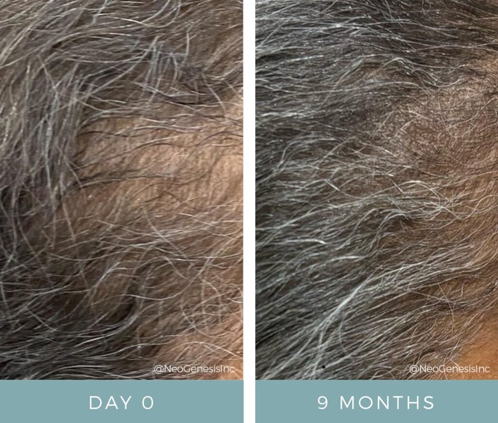 Before + After - Hair Loss - Androgenetic Alopecia + Alopecia Areata