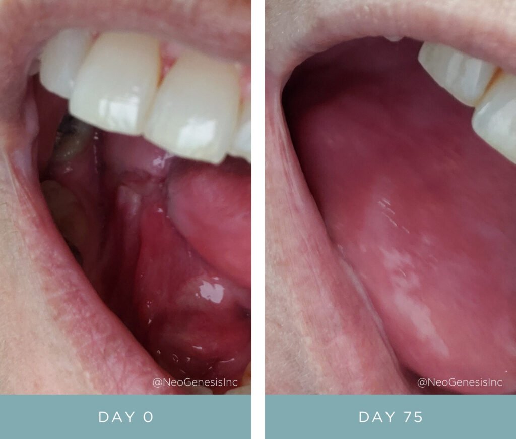 Before + After - Tongue Cancer Surgery + Radiation