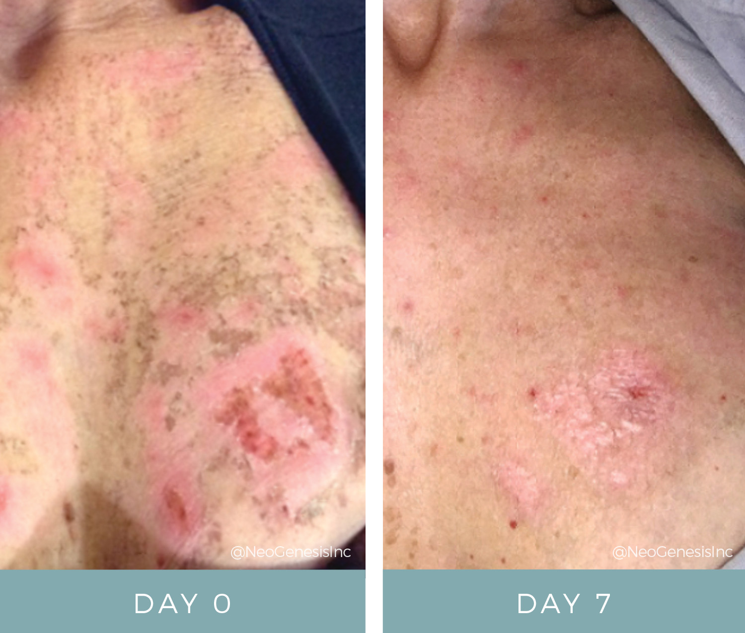 Before + After - IPL Laser Burn