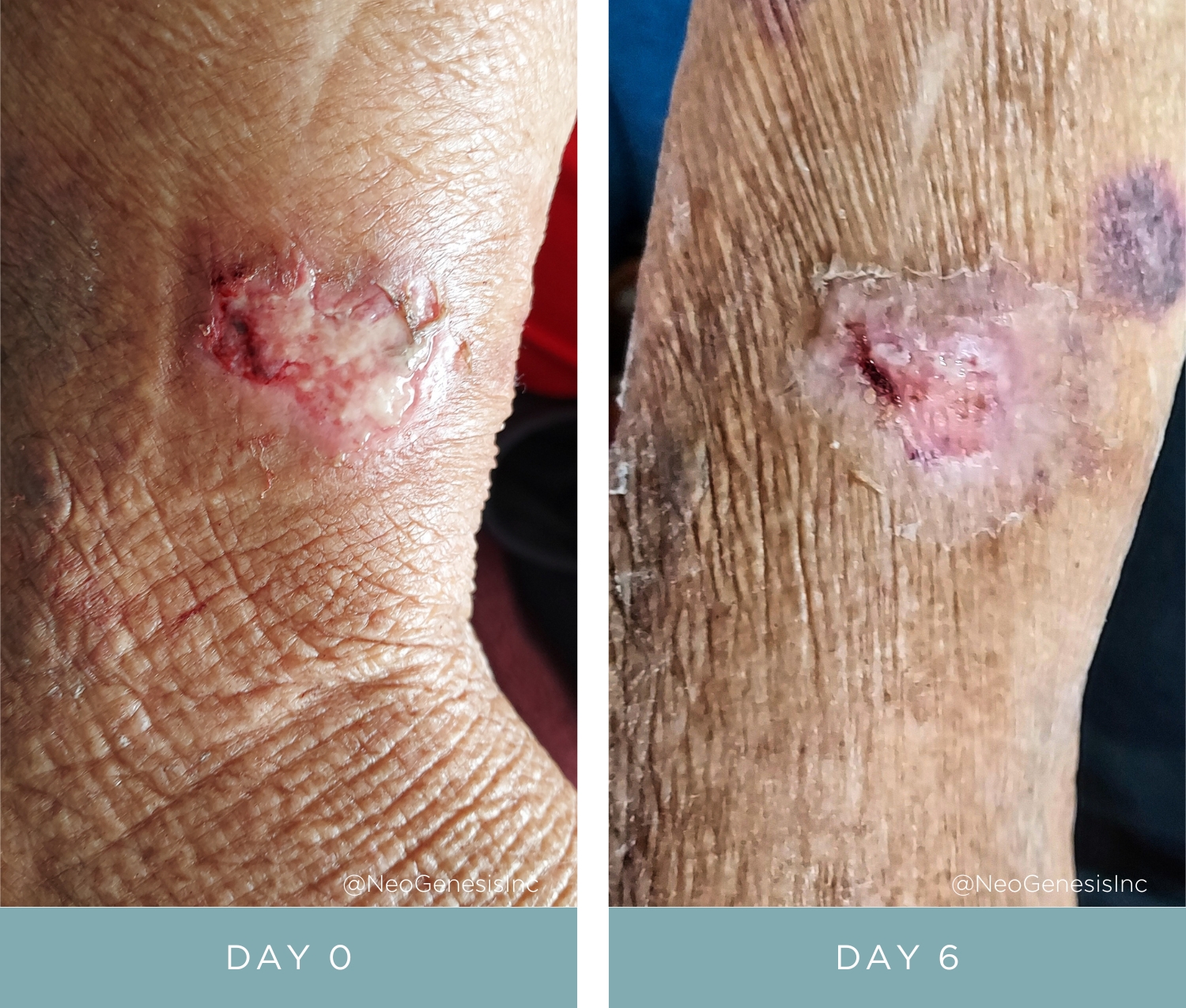 Before + After - Wound Care for Diabetics