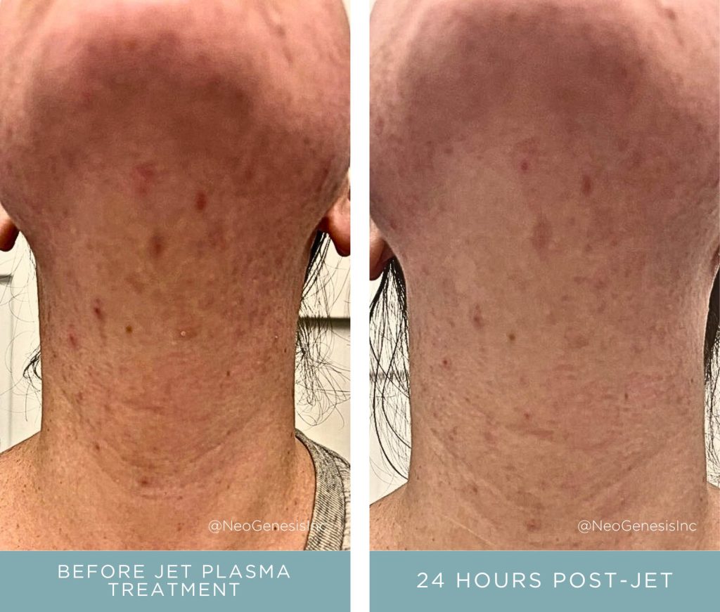 Before + After - Acne + Jet Plasma