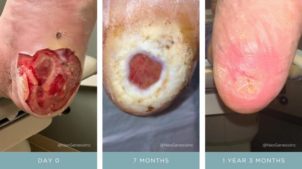 Before + After - Diabetic Ulcer