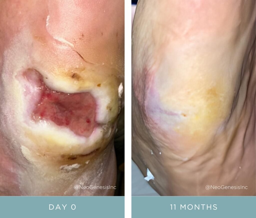 Before + After - Diabetic Ulcer