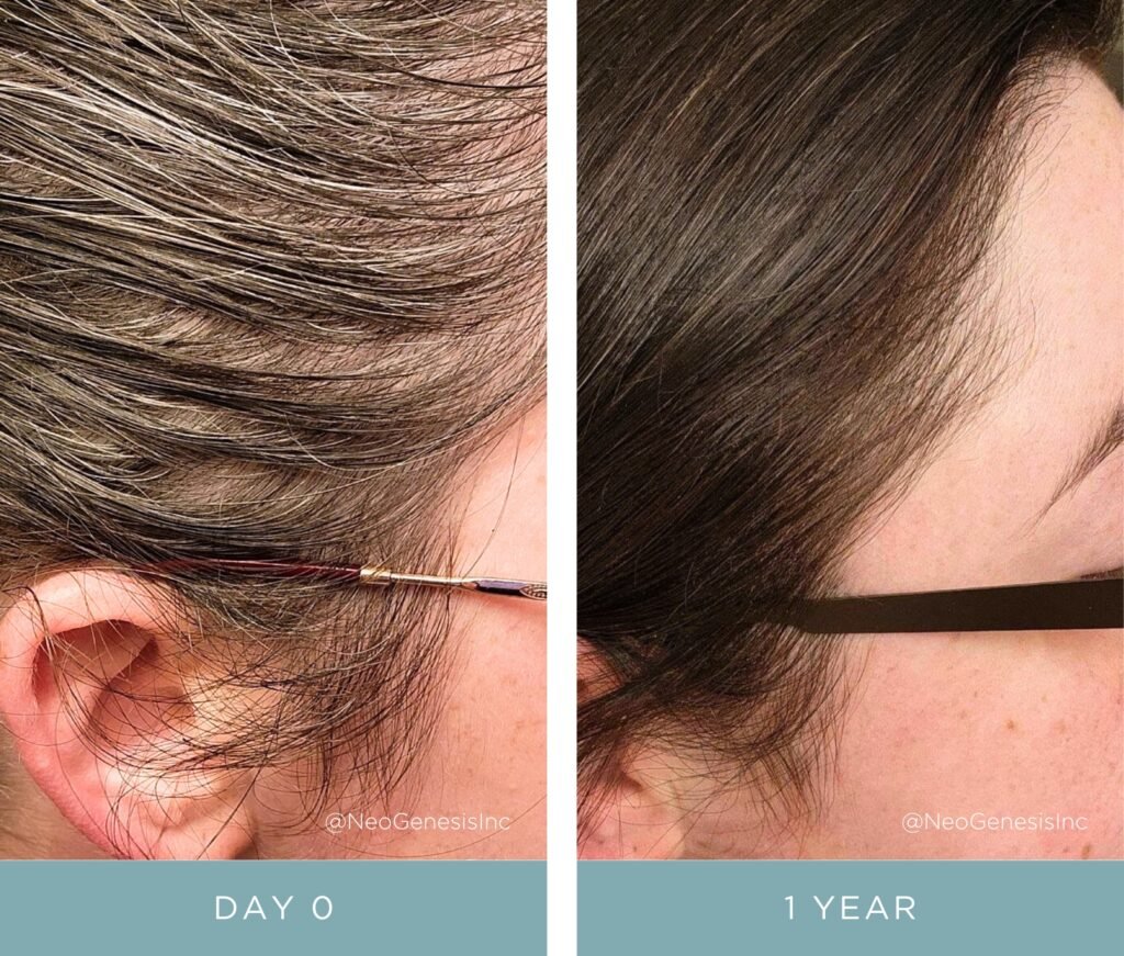 Before + After - Hair Loss + Jet Treatments