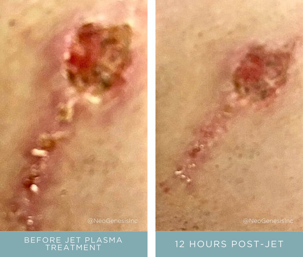 Before + After - Wound Care - Burn