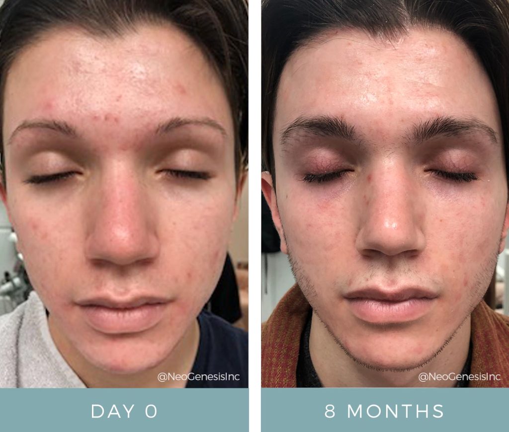 Before + After - Cystic Acne