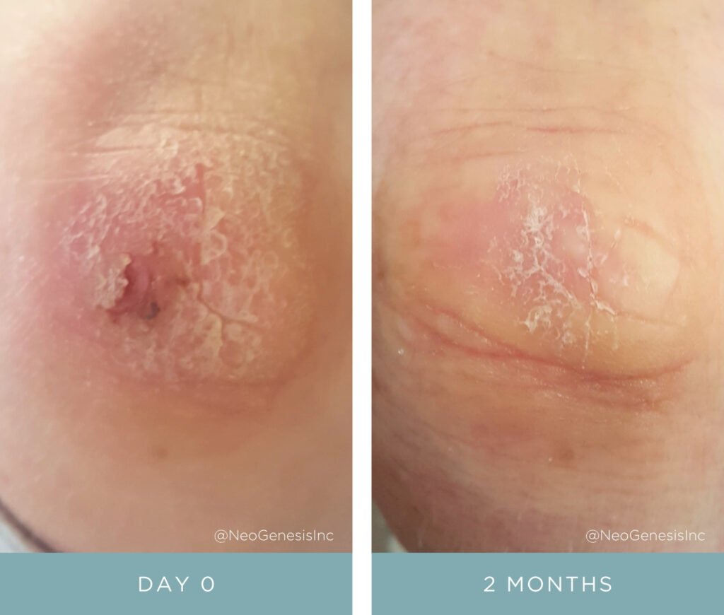 Before + After - Wound care for open sores and dry, aging skin