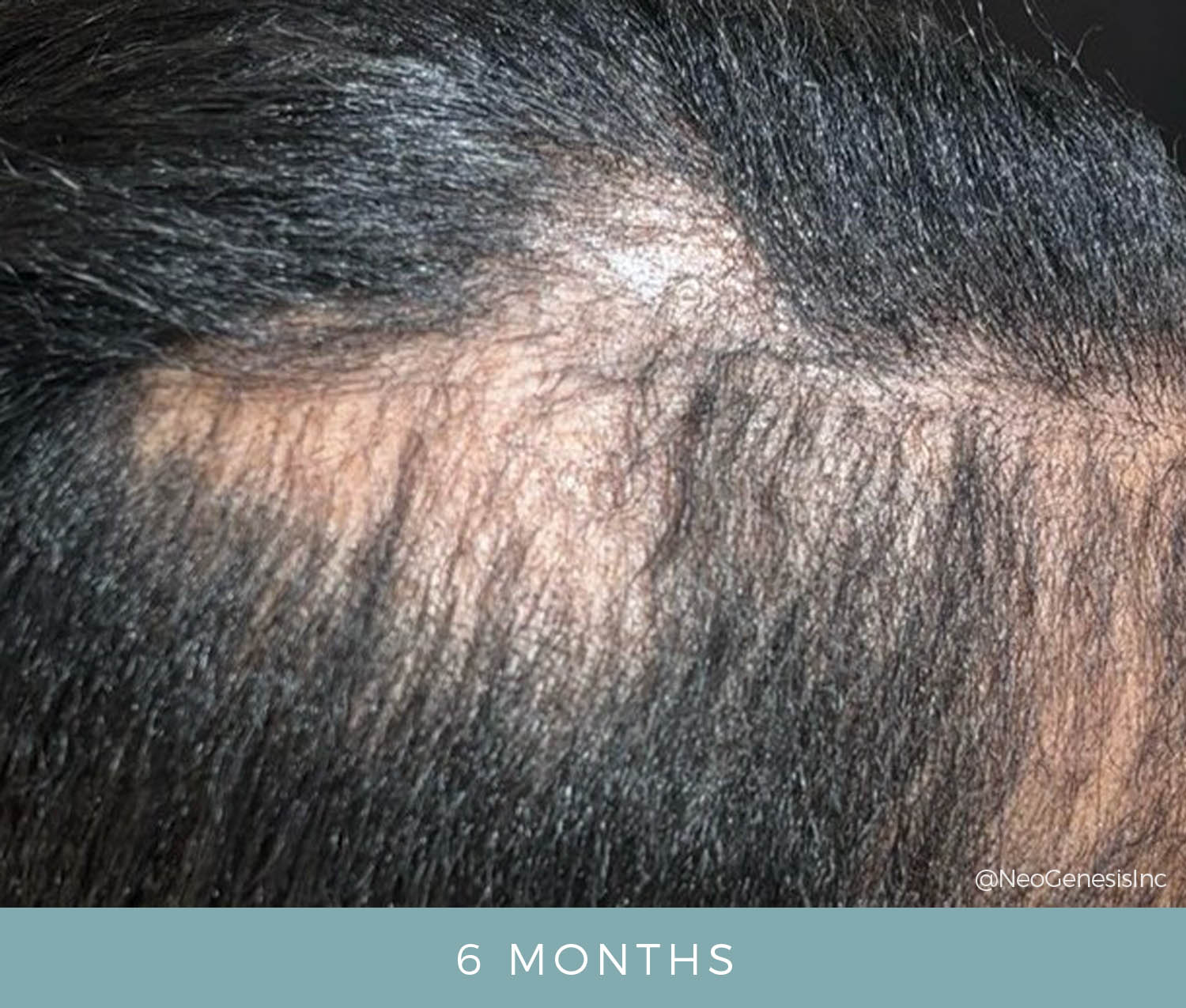 Hair Loss - Alopecia Areata