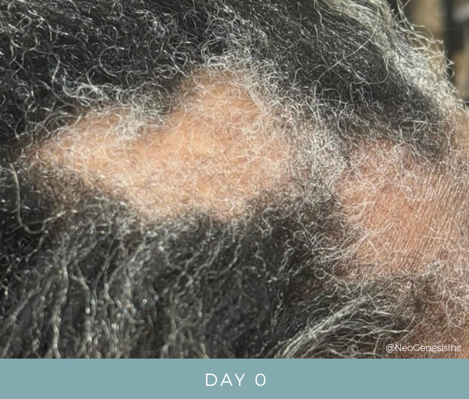 Hair Loss - Alopecia Areata