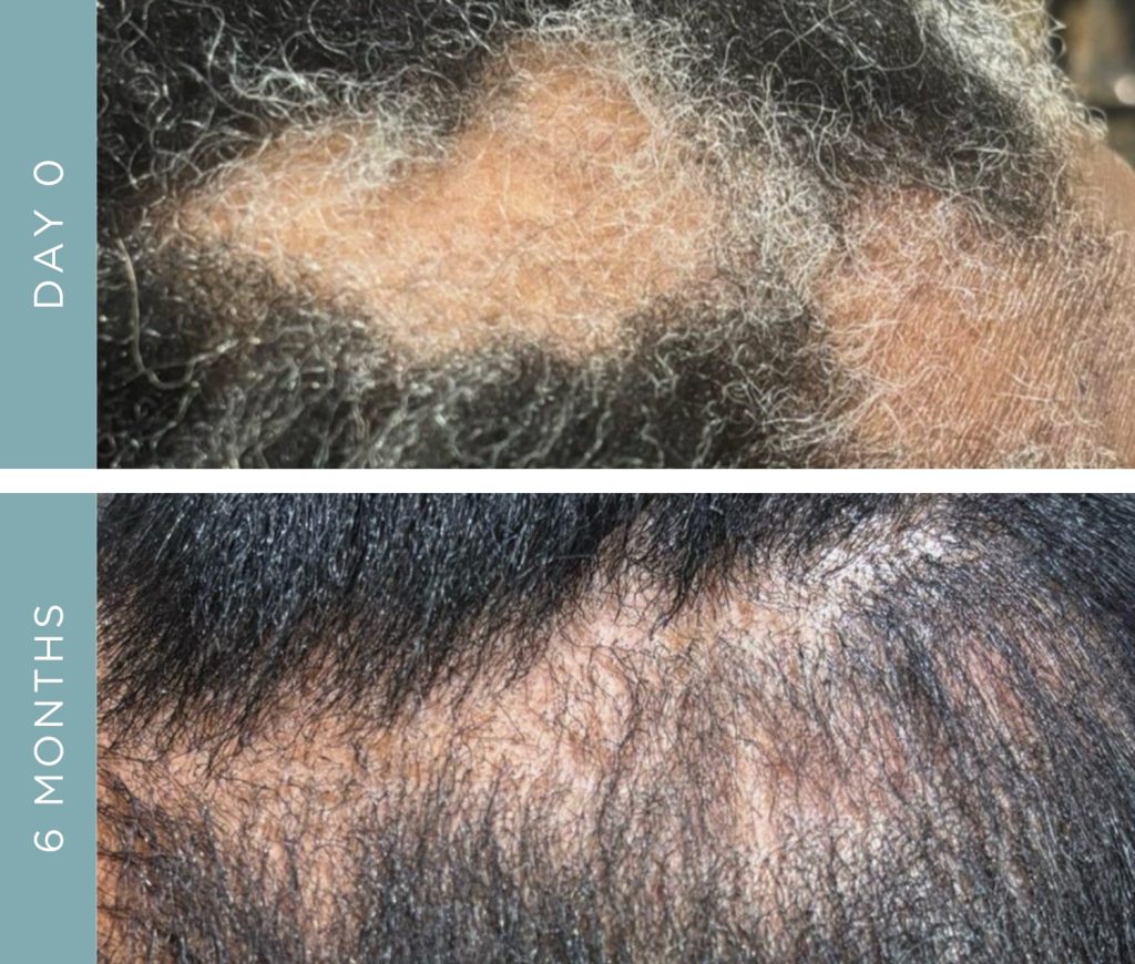 Before + After - Hair Loss - Alopecia Areata