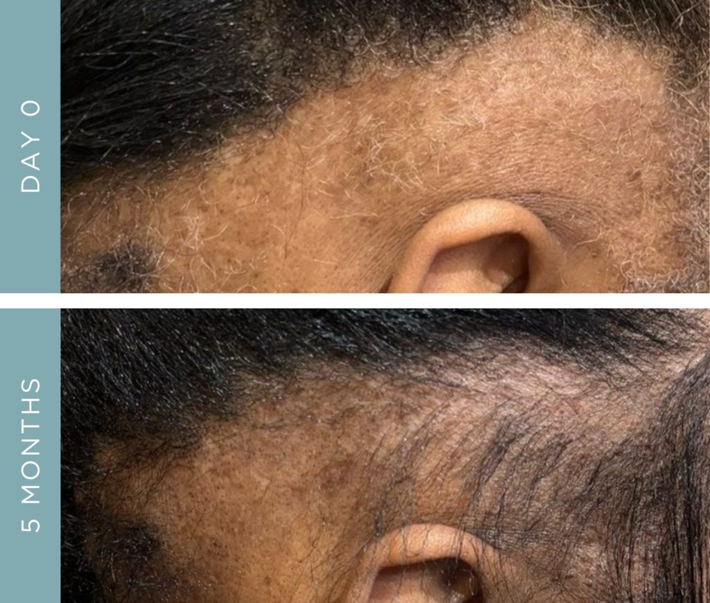 Before + After - Alopecia Areata - Hair Loss