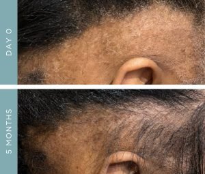 Before + After - Alopecia Areata - Hair Loss