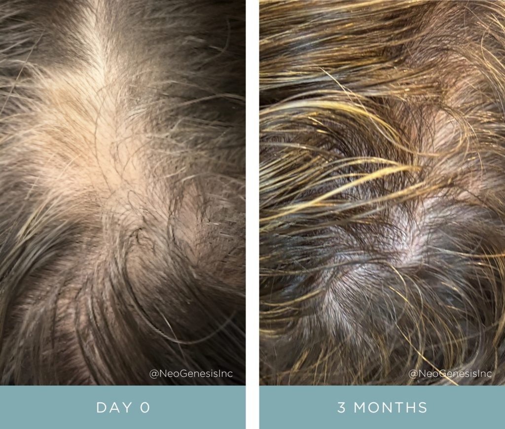 Before + After - Hair loss caused by stress