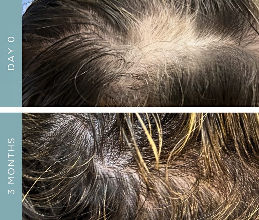 Before + After - Hair Loss