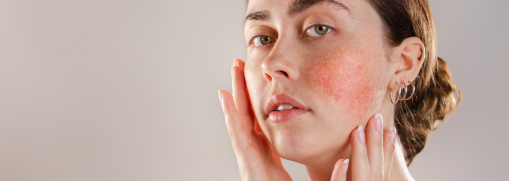 Managing Rosacea - Skincare blog by NeoGenesis