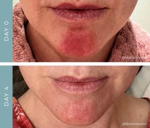 Before + After - Perioral Dermatitis