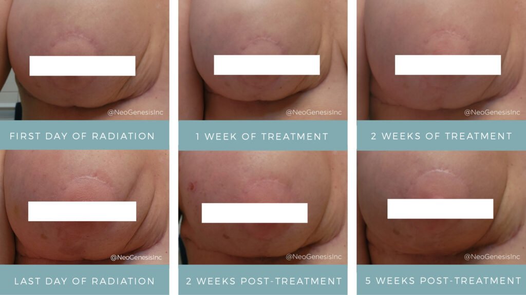 Before + After - Radiation after double mastectomy