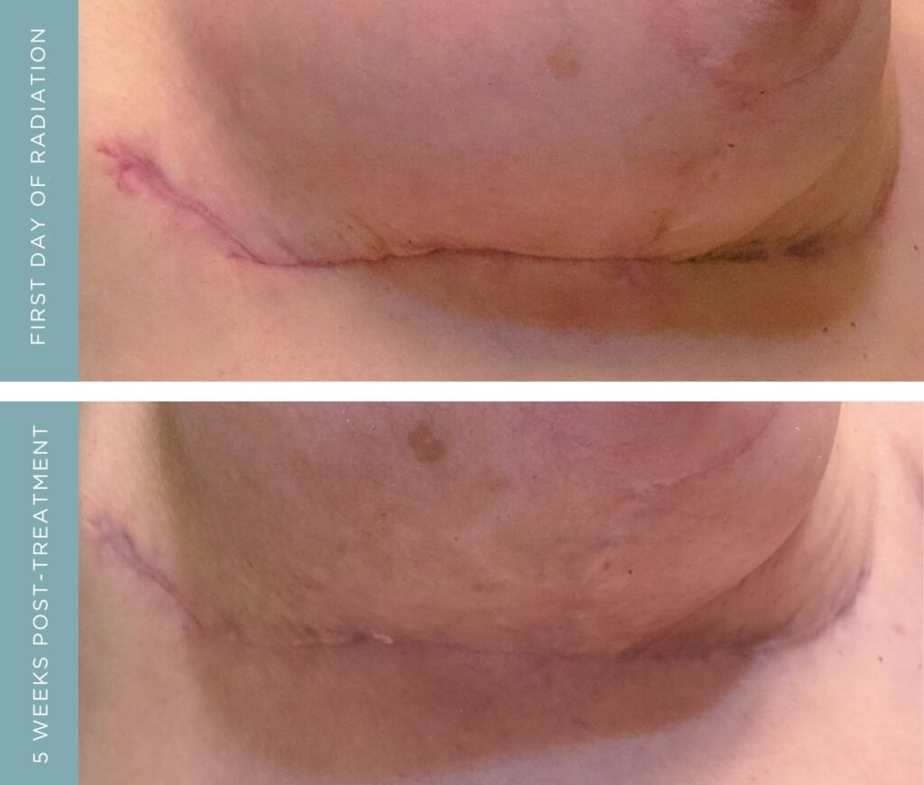 Before + After - Radiation + Cancer Surgery