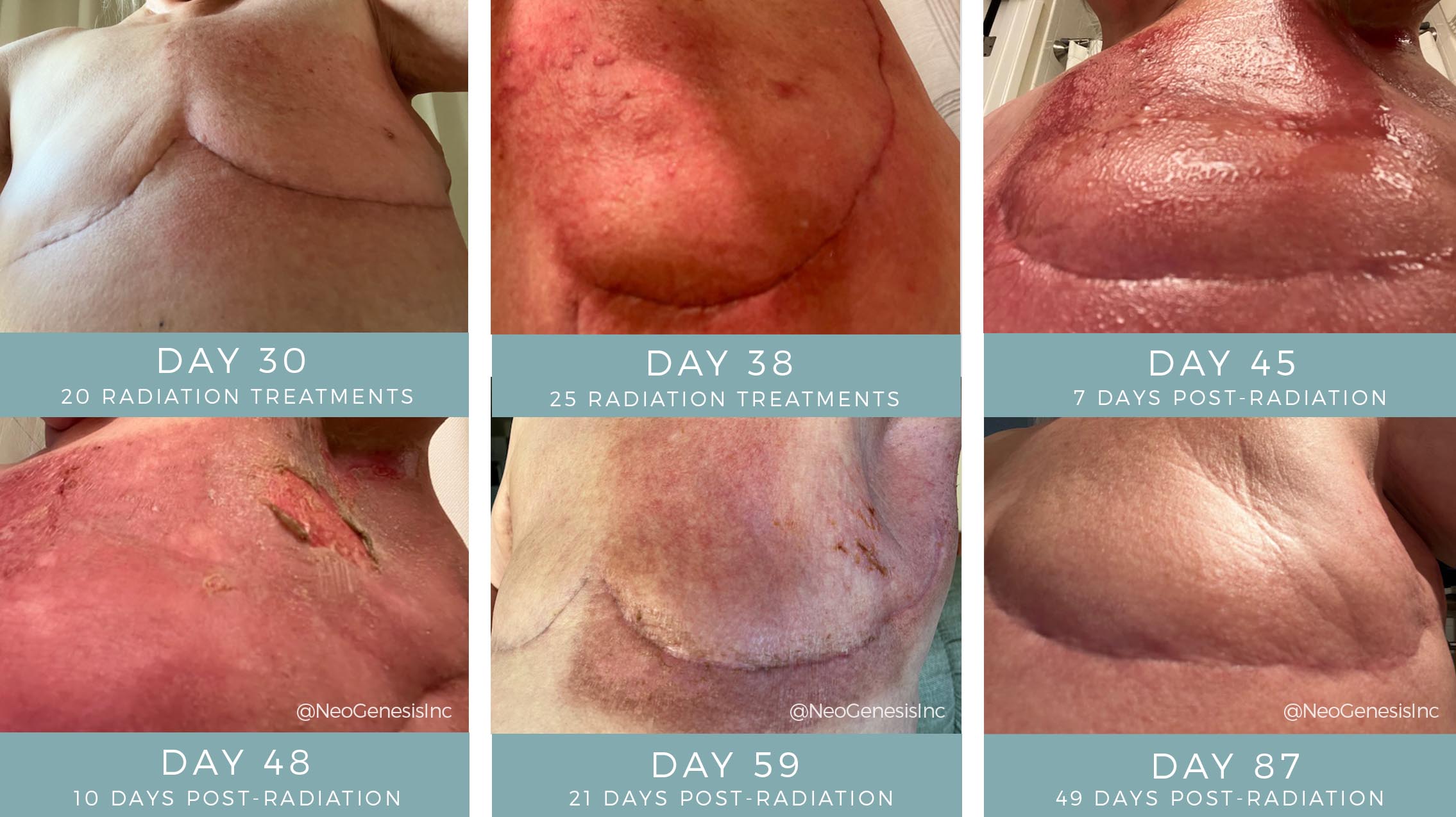 Before + After - Radiation Burns - Breast Cancer