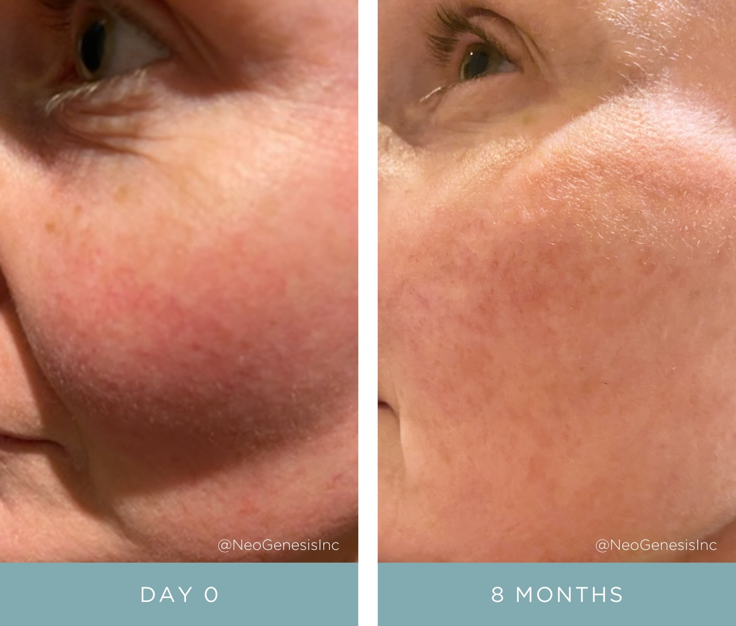 Before + After - Rosacea