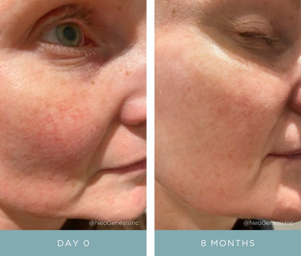 Before + After - Rosacea