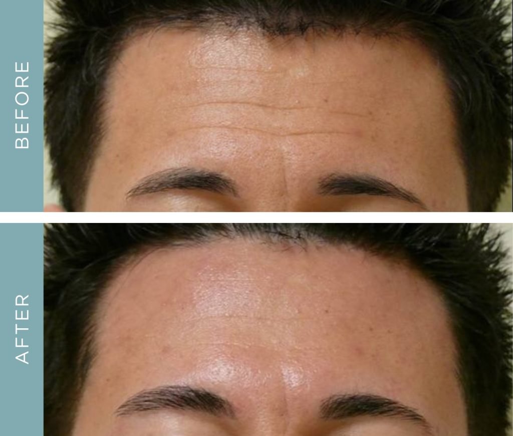 Before + After - Aging Skin on Forehead