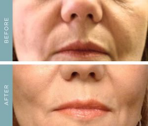 Before + After - Aging - Lower Face