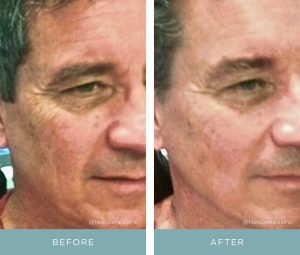 Before + After - Aging Skin + Hyperpigmentation - Male