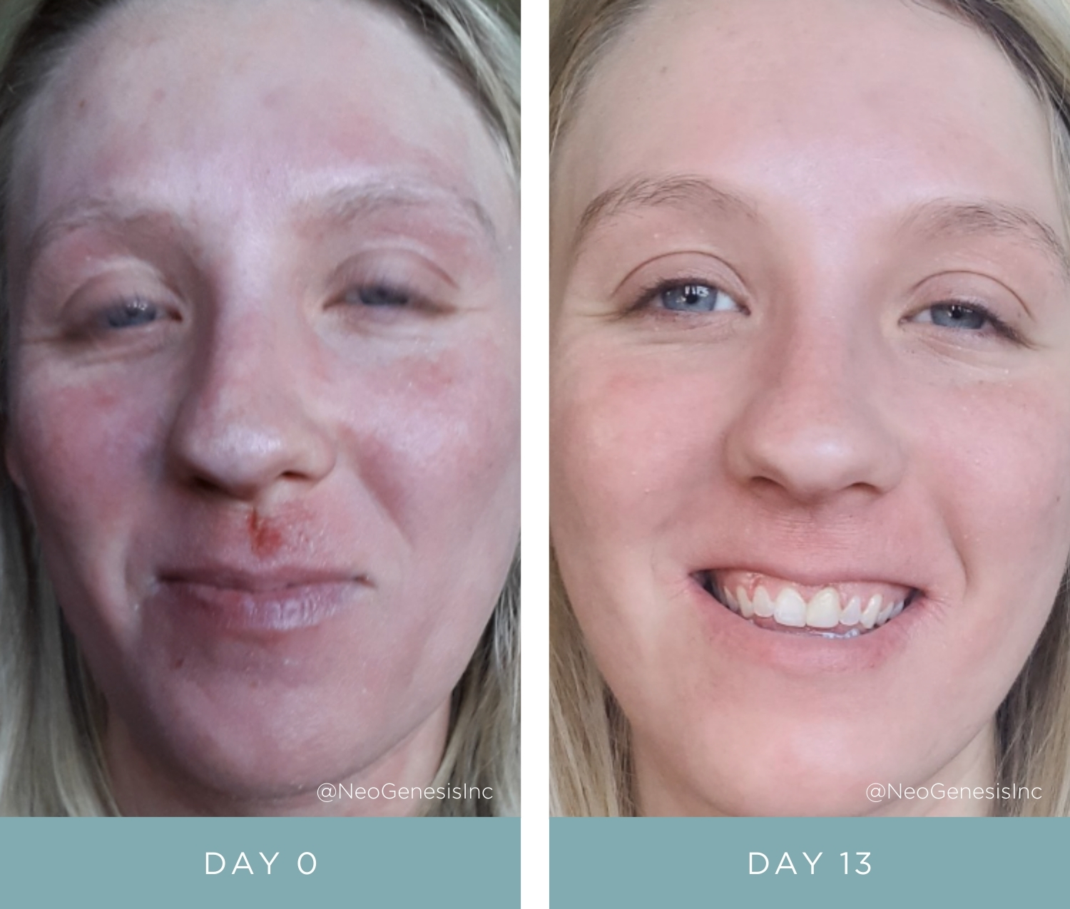 Before + After - Eczema during Pregnancy