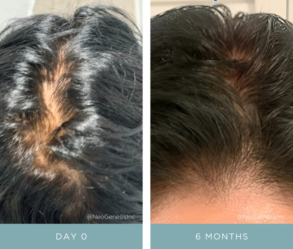 Hair Loss - NeoGenesis Hair Thickening Serum + Microneedling