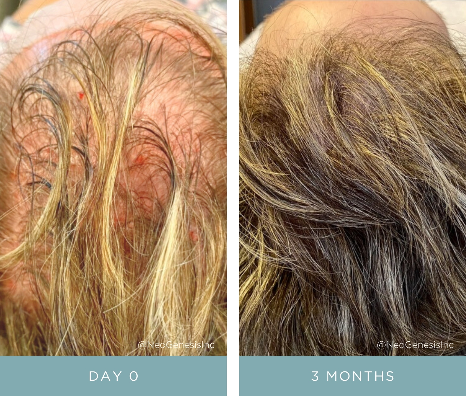 Before + After - Hair Loss - PRP + NeoGenesis Hair Thickening Serum