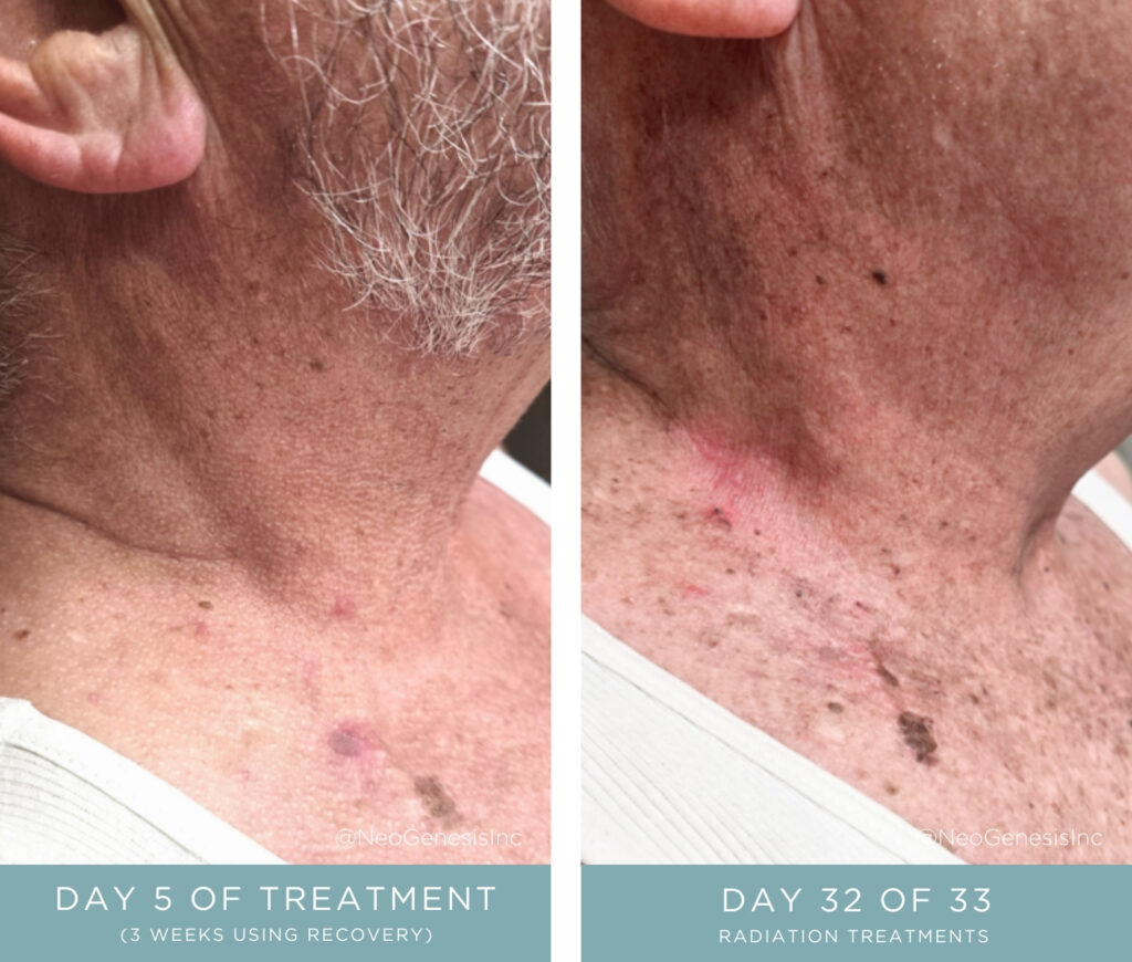 Before + After Radiation for Oral Squamous Cell Carcinoma