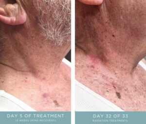 Before + After Radiation for Oral Squamous Cell Carcinoma