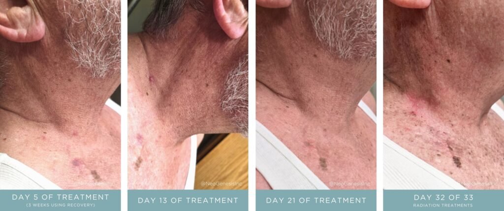 Before + After - Oral Squamous Cell Carcinoma Cancer Surgery, Chemo, Radiation