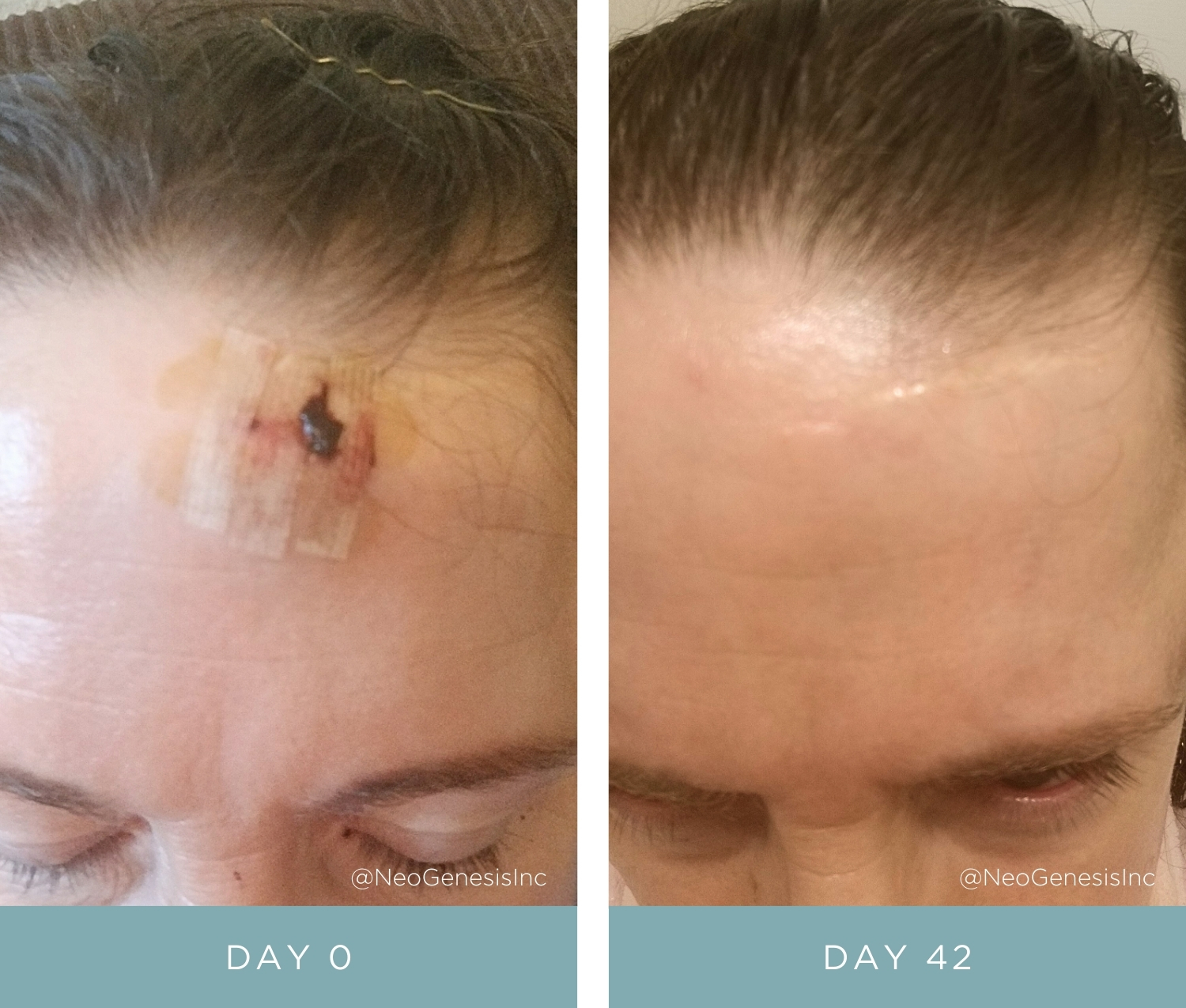 Before + After - Surgery Scarring for Birthmark Removal