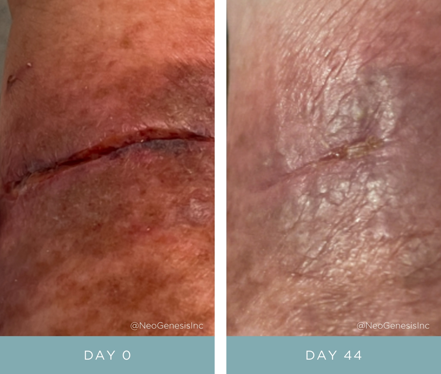 Before + After - Wound Care for Diabetics