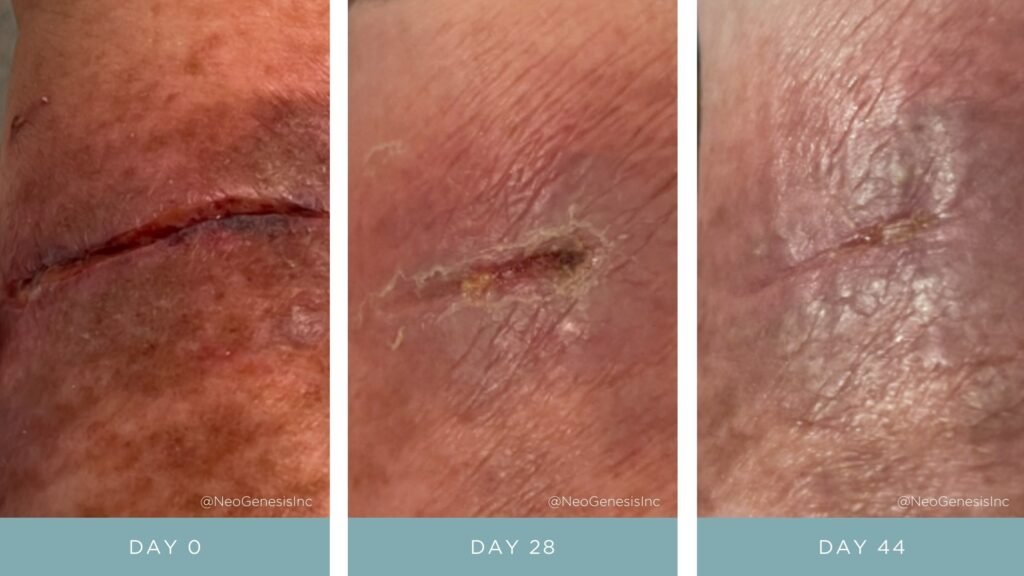 Before + After - Wound Care for Diabetics