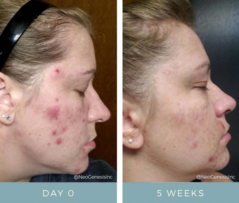 Before + After - Acne