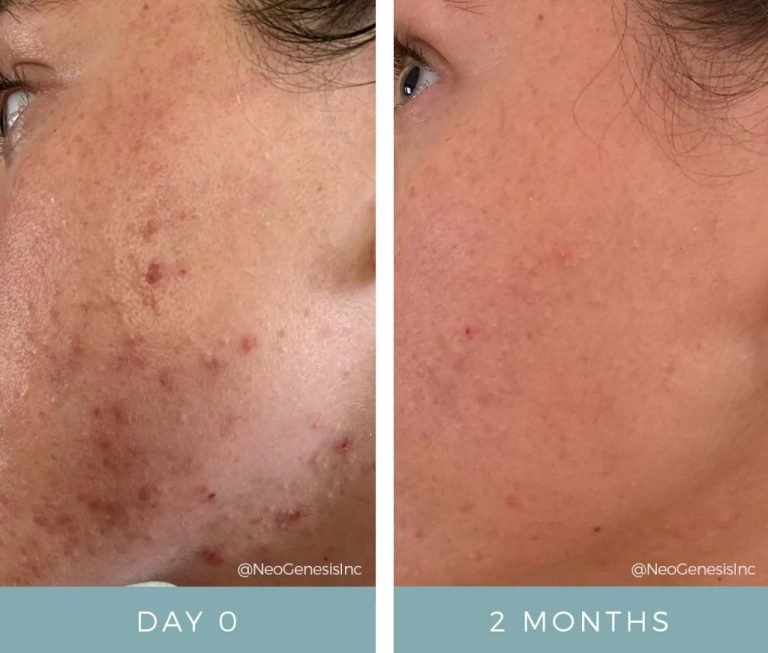 Before + After - Acne