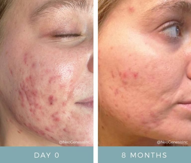 Before + After - Acne