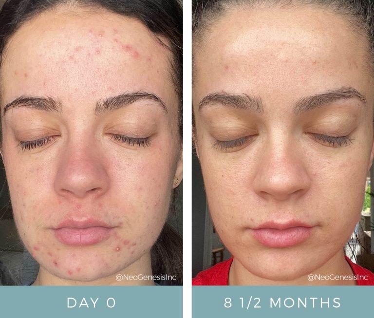 Before + After - Hormonal Acne