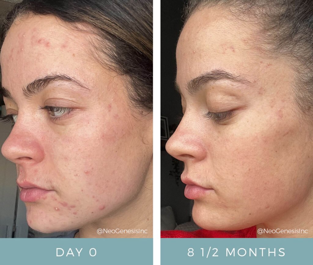 Before + After - Acne