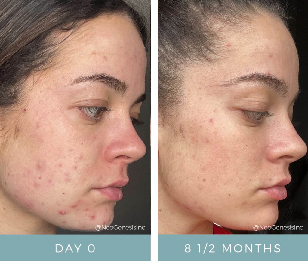 Before + After - Acne