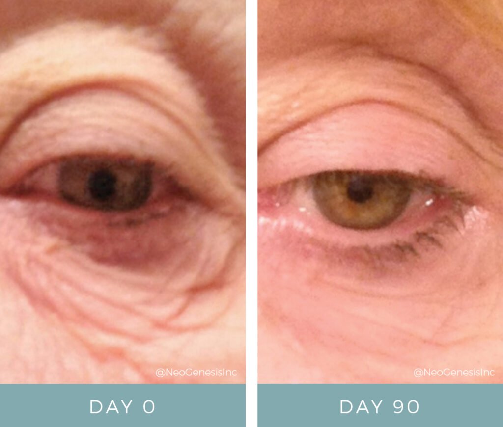 Before & After - Aging Skin - Eye