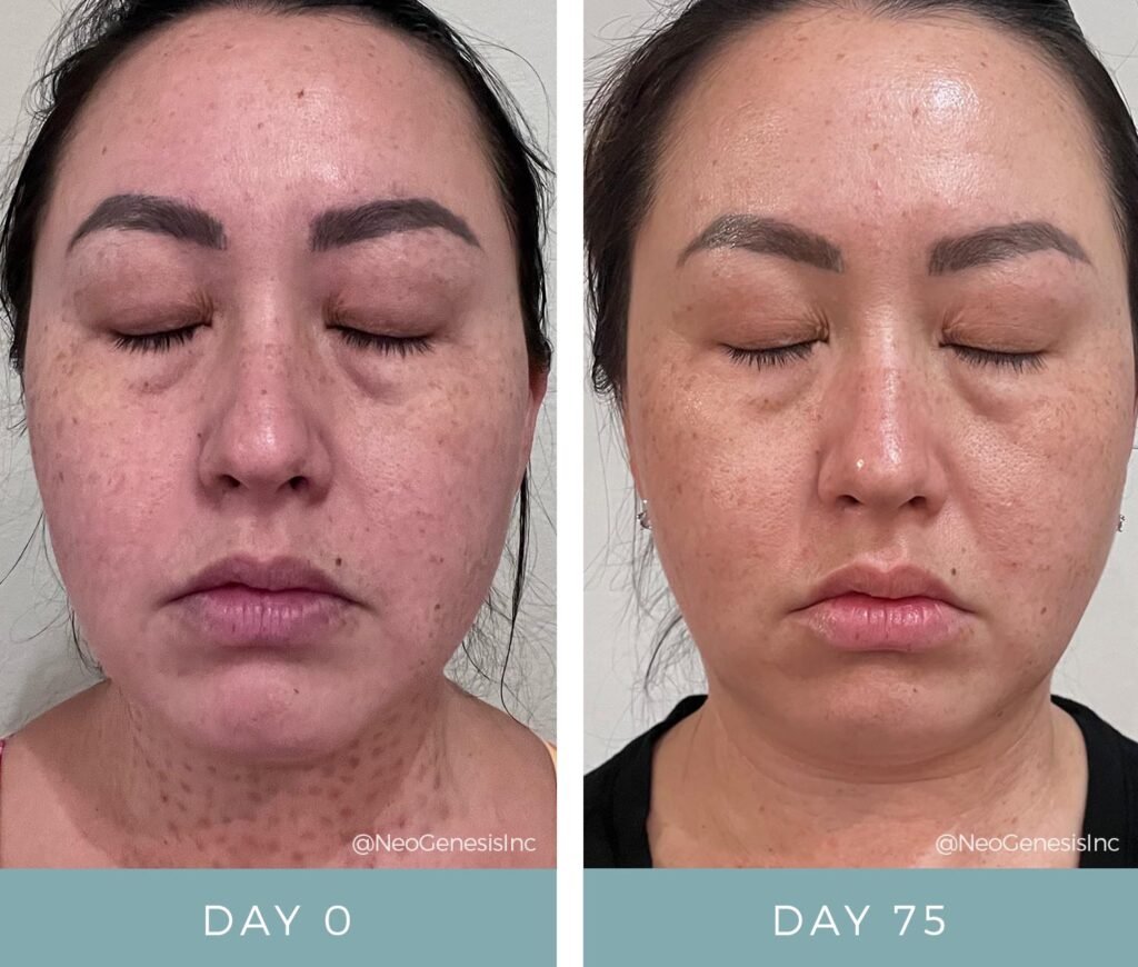 Before + After - Fibroblast Scarring + Aging Skin + Hyperpigmentation