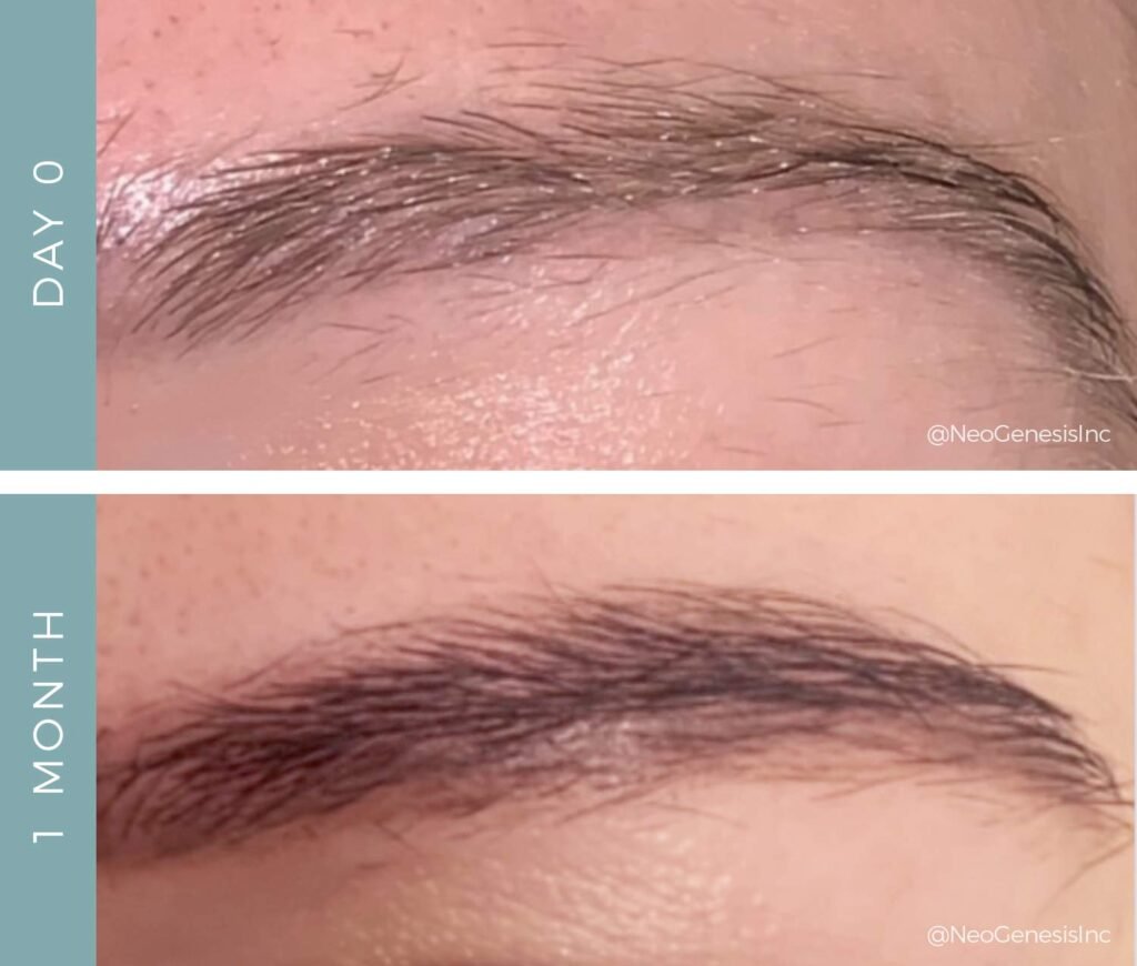 Before + After - Brow Loss