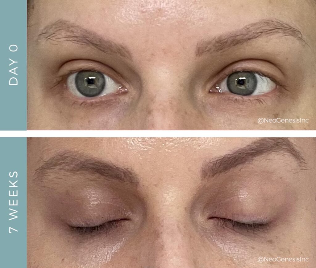 Before + After - Brow Loss from Chemo